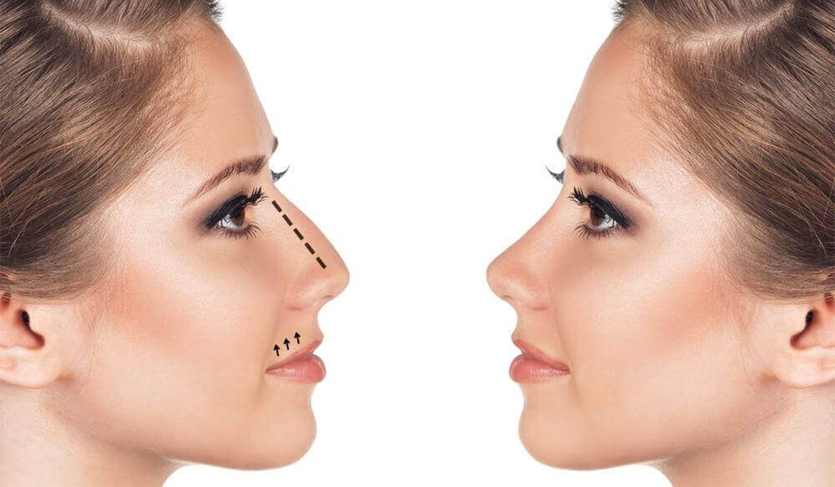 Ринопластика в Івано-Франківську