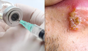 Вакцинація проти вірусу папіломи людини