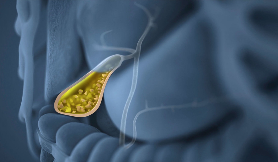 Холецистит – хвороба, яку небезпечно запускати