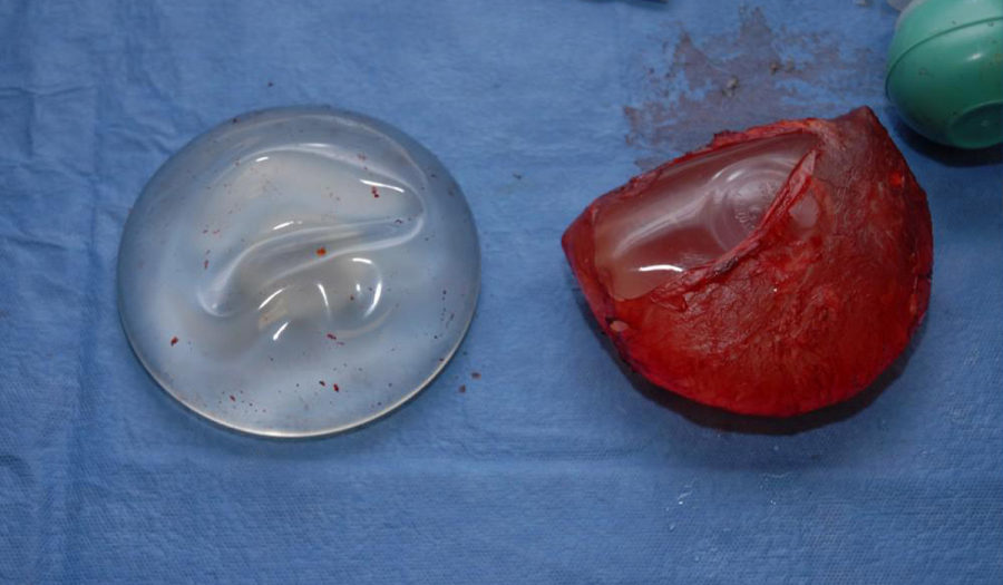 ІМПЛАНТ-асоційована лімфома