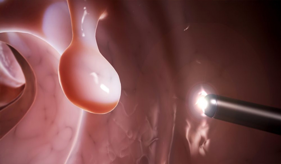 Все, що потрібно знати про колоноскопію