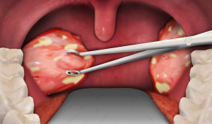 Тонзилектомія (видалення мигдалин) у Івано-Франківську