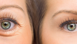 Позбавтесь від зморшок! Ін'єкції ботулотоксину в Івано-Франківську.