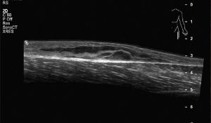 Що показує УЗД м'яких тканин?