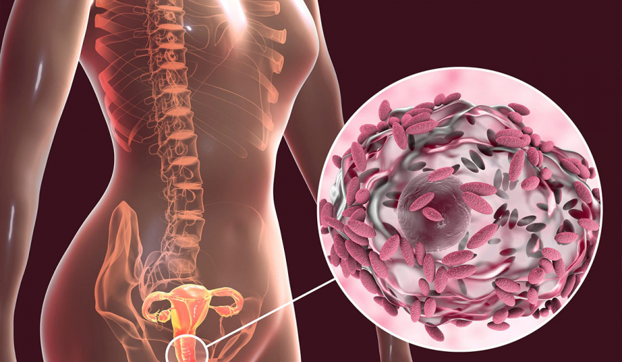 Чи знаєте ви, що таке вагініт?