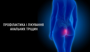 Профілактика і лікування анальних тріщин