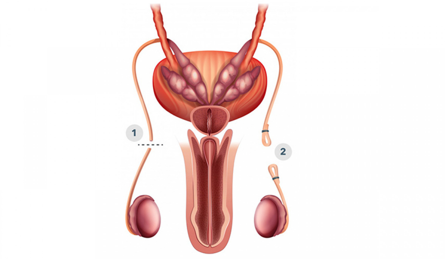 Вазектомія.Чоловіча стерилізація у Івано-Франківську