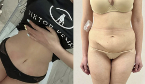 Абдомінопластика+ліпосакція