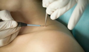 Папіломи на тілі – це не родимки. Чи варто їх видаляти?