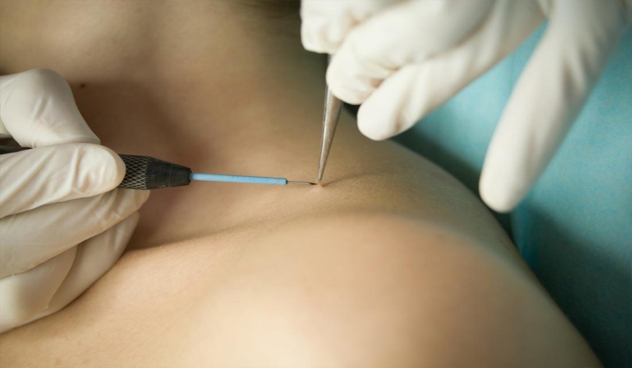 Папіломи на тілі – це не родимки. Чи варто їх видаляти?