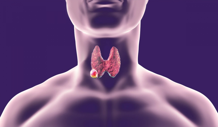 Діагностика та лікування онкології щитоподібної залози