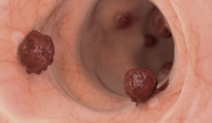 Чи можна попередити колоректальний рак?