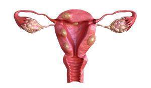 Міомектомія