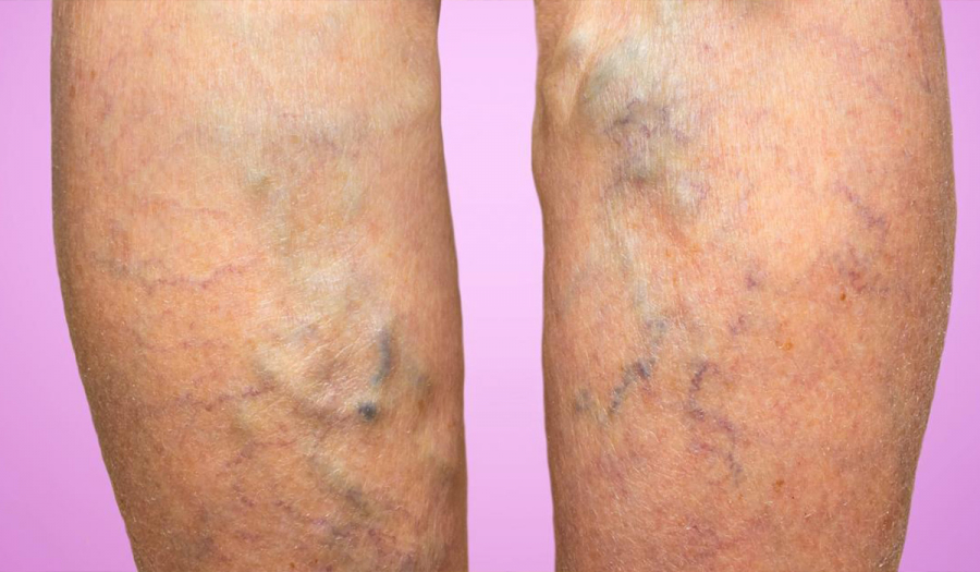 Хірургічне лікування варикозу в МЦ «МЕДХАУЗ»