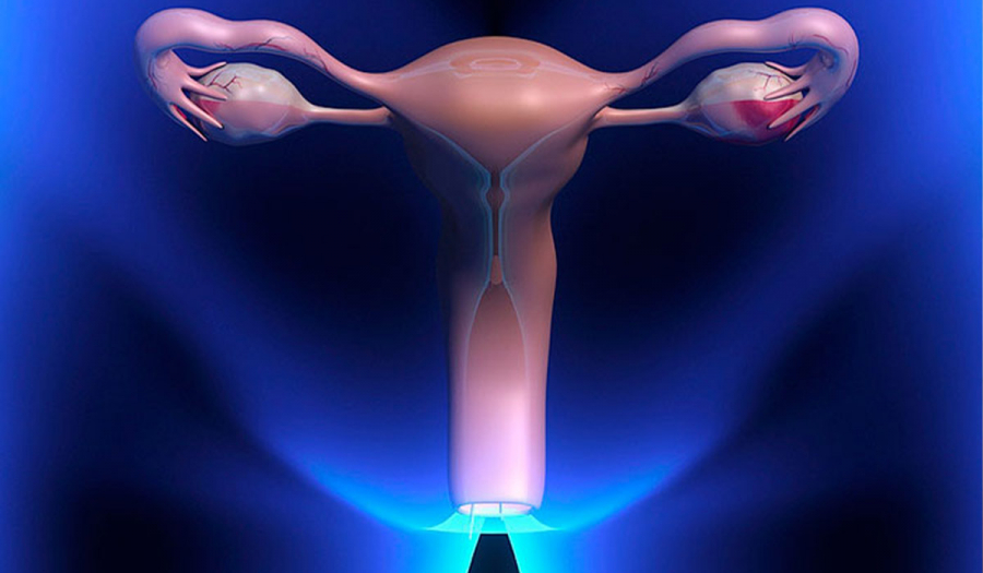 Ін’єкційна вестибулопластика (Звуження входу в піхву за допомогою філлерів на основі гіалуронової кислоти)