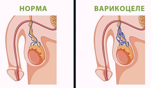 Лікування варикоцеле в Івано-Франківську