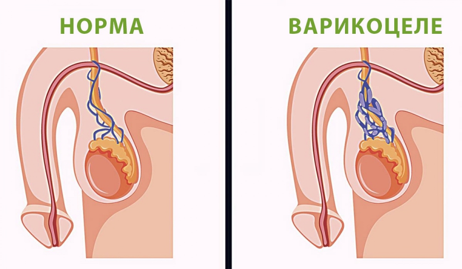 Лікування варикоцеле в Івано-Франківську