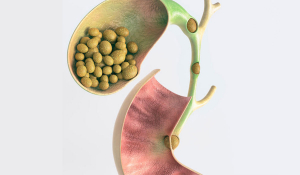 Жовчнокам'яна хвороба: Сучасні підходи до діагностики та лікування в Івано-Франківську