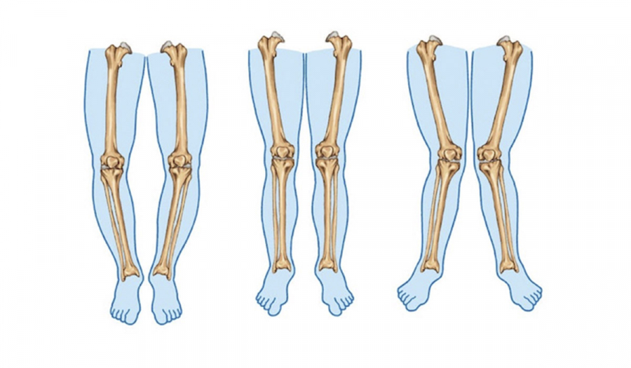 Коригуюча остеотомія: відновлення руху та якості життя