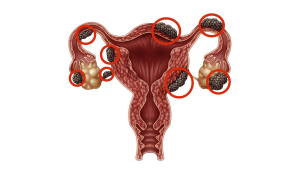 Ендометріоз