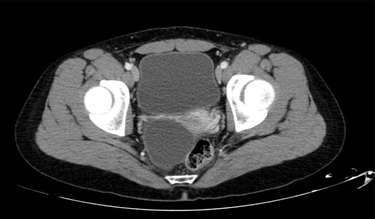 Успішне лікування пацієнтки з кістою бартолінової залози