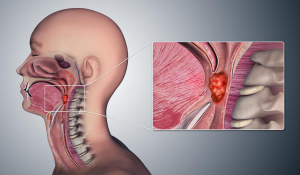 Рак ротоглотки зустрічається у 8% онкопацієнтів.