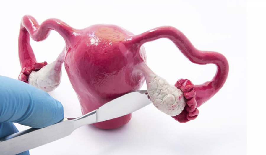 Оваріектомія — операція з видалення одного або двох яєчників